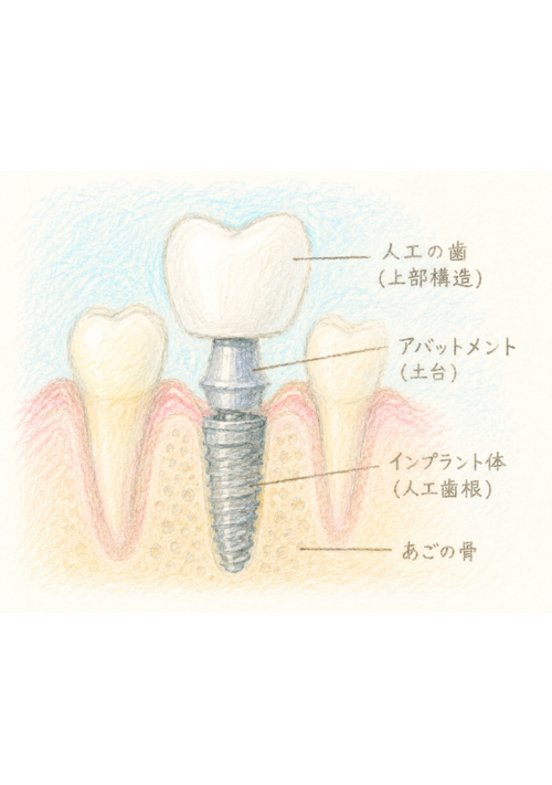 『インプラント一本５０万円は相場なのかな』（まいゆき） 表紙